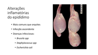 Alterações
inflamatórias
do epidídimo
• Mais comuns que orquites
• Infecção ascendente
• Doenças infecciosas:
• Brucela spp
• Staphylococcus spp
• Escherichia coli
 
