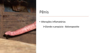Pênis
• Alterações inflamatórias
Glande e prepúcio - Balonopostite
 