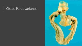 Cistos Paraovarianos
 