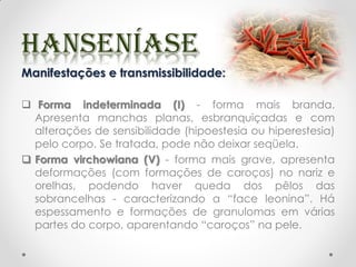 Manifestações e transmissibilidade:
 Forma indeterminada (I) - forma mais branda.
Apresenta manchas planas, esbranquiçadas e com
alterações de sensibilidade (hipoestesia ou hiperestesia)
pelo corpo. Se tratada, pode não deixar seqüela.
 Forma virchowiana (V) - forma mais grave, apresenta
deformações (com formações de caroços) no nariz e
orelhas, podendo haver queda dos pêlos das
sobrancelhas - caracterizando a “face leonina”. Há
espessamento e formações de granulomas em várias
partes do corpo, aparentando “caroços” na pele.
 