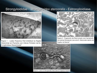 Strongyloididae -Strongyloididae - Strongyloides stercoralisStrongyloides stercoralis - Estrongiloidíase.- Estrongiloidíase.
 