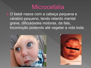  O bebê nasce com a cabeça pequena e
cérebro pequeno, tendo retardo mental
grave, dificuldades motoras, da fala,
locomoção podendo até vegetar a vida toda.
 