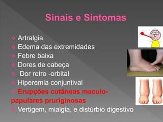  Artralgia
 Edema das extremidades
 Febre baixa
 Dores de cabeça
 Dor retro -orbital
 Hiperemia conjuntival
 Erupções cutâneas maculo-
papulares pruriginosas
 Vertigem, mialgia, e distúrbio digestivo
 