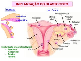 IMPLANTAÇÃO DO BLASTOCISTO
NORMAL ECTÓPICA
Implantação anormal (ectópica)
- Ovariana
- Abdominal
- Pélvica
- Tubária
miométrio
endométrio
 