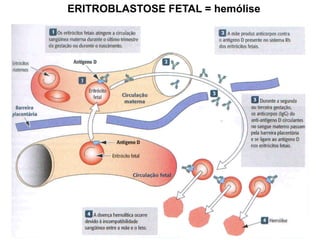 ERITROBLASTOSE FETAL = hemólise
 
