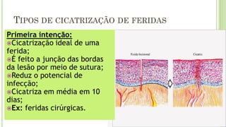 TIPOS DE CICATRIZAÇÃO DE FERIDAS
Primeira intenção:
Cicatrização ideal de uma
ferida;
É feito a junção das bordas
da lesão por meio de sutura;
Reduz o potencial de
infecção;
Cicatriza em média em 10
dias;
Ex: feridas cirúrgicas.
 