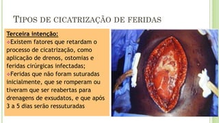 TIPOS DE CICATRIZAÇÃO DE FERIDAS
Terceira intenção:
❖Existem fatores que retardam o
processo de cicatrização, como
aplicação de drenos, ostomias e
feridas cirúrgicas infectadas;
❖Feridas que não foram suturadas
inicialmente, que se romperam ou
tiveram que ser reabertas para
drenagens de exsudatos, e que após
3 a 5 dias serão ressuturadas
 