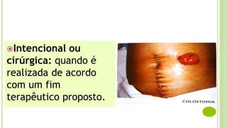 Intencional ou
cirúrgica: quando é
realizada de acordo
com um fim
terapêutico proposto.
 