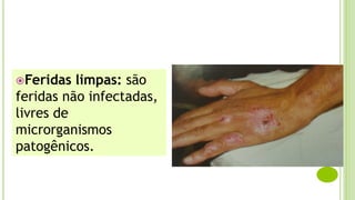 Feridas limpas: são
feridas não infectadas,
livres de
microrganismos
patogênicos.
 