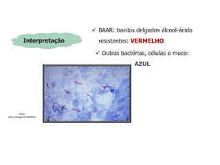 Interpretação
 BAAR: bacilos delgados álcool-ácido
resistentes: VERMELHO
 Outras bactérias, células e muco:
AZUL
Fonte:
https://binged.it/32RhMv6
 