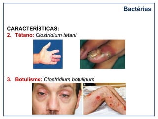 Bactérias
CARACTERÍSTICAS:
2. Tétano: Clostridium tetani
3. Botulismo: Clostridium botulinum
 
