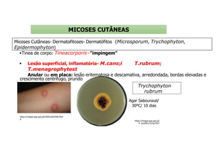 MICOSES CUTÂNEAS
Micoses Cutâneas- Dermatofitoses- Dermatófitos (Microsporum, Trychophyton,
Epidermophyton)
Tinea de corpo: Tineacorporis–“impingem”
 Lesão superficial, inflamatória- M.cans;i T.rubrum;
T.menagrophytest
Anular ou em placa: lesão eritematosa e descamativa, arredondada, bordas elevadas e
crescimento centrífugo, prurido
https://images.app.goo.gl/nXXEuGbZrWAi7AxS
A
Trychophyton
rubrum
https://images.app.goo.gl/
R g1wPPxT2LFsy79h7
Agar Sabouraud/
30ºC/ 10 dias
 