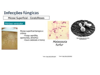 Infecções fúngicas
Micose Superficial - Ceratofitoses
Pitiríase versicolor
Malassezia
furfur
Fonte: http://bit.ly/30TLQUP Fonte: http://bit.ly/2Sy3XwO
https://images.app.goo.gl/Jx5o
MG3976jV4Frv8 q
Micose superficial benigna e
crônica
-Fungo saprófita,
oportunista, dimórfico
-Couro cabeludo e tronco
 