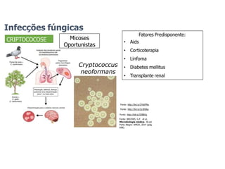 Infecções fúngicas
CRIPTOCOCOSE
Cryptococcus
neoformans
Fonte: http://bit.ly/2Z88iJq
Fonte: BROOKS, G.F. et al.
Microbiologia médica. 26.ed.
Porto Alegre: AMGH, 2014 (pág.
698).
Fonte: http://bit.ly/2YbEPNs
Fonte: http://bit.ly/2y3E66p
Micoses
Oportunistas
Fatores Predisponente:
• Aids
• Corticoterapia
• Linfoma
• Diabetes mellitus
• Transplante renal
 