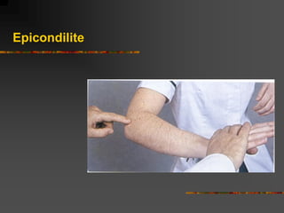 Epicondilite
 
