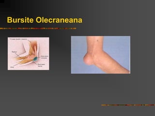 Bursite Olecraneana
 