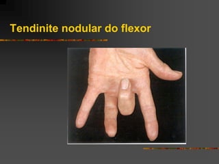 Tendinite nodular do flexor
 