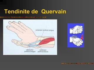 Tendinite de Quervain
 