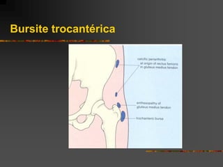 Bursite trocantérica
 