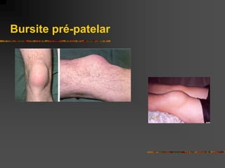 Bursite pré-patelar
 