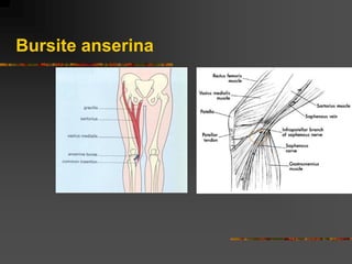 Bursite anserina
 