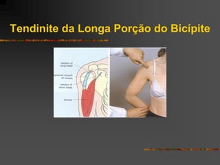 Tendinite da Longa Porção do Bicípite
 