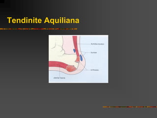 Tendinite Aquiliana
 