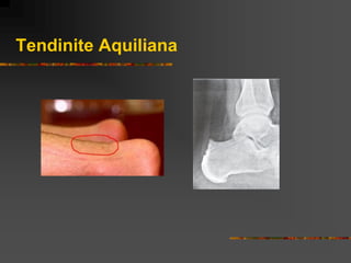 Tendinite Aquiliana
 