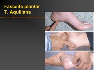 Fasceíte plantar
T. Aquiliana
 