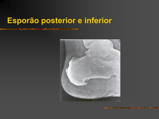 Esporão posterior e inferior
 