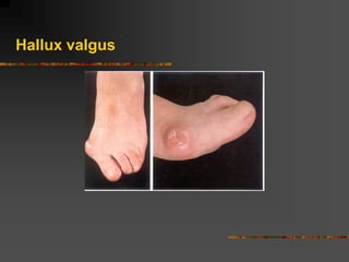 Hallux valgus
 
