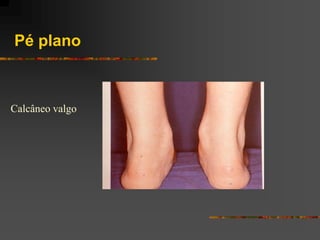 Pé plano



Calcâneo valgo
 