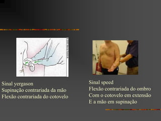 Sinal yergason                   Sinal speed
Supinação contrariada da mão     Flexão contrariada do ombro
Flexão contrariada do cotovelo   Com o cotovelo em extensão
                                 E a mão em supinação
 