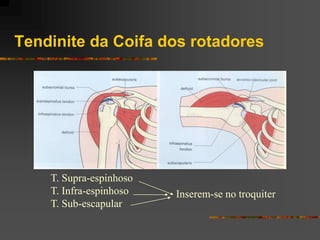 Tendinite da Coifa dos rotadores




    T. Supra-espinhoso
    T. Infra-espinhoso   Inserem-se no troquiter
    T. Sub-escapular
 