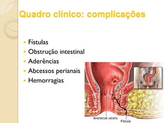 Quadro clínico: complicações
 Fístulas
 Obstrução intestinal
 Aderências
 Abcessos perianais
 Hemorragias
 