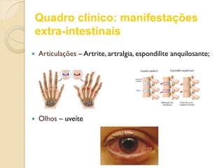 Quadro clínico: manifestações
extra-intestinais
 Articulações – Artrite, artralgia, espondilite anquilosante;
 Olhos – uveíte
 