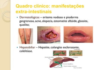 Quadro clínico: manifestações
extra-intestinais
 Dermatológicas – eritema nodoso e pioderma
gangrenoso, acne, alopecia, estomatite aftóide, glossite,
queilite;
 Hepatobiliar – Hepatite, colangite esclerosante,
colelitíase.
 