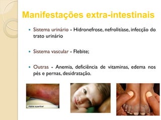 Manifestações extra-intestinais
 Sistema urinário - Hidronefrose, nefrolitíase, infecção do
trato urinário
 Sistema vascular - Flebite;
 Outras - Anemia, deficiência de vitaminas, edema nos
pés e pernas, desidratação.
 