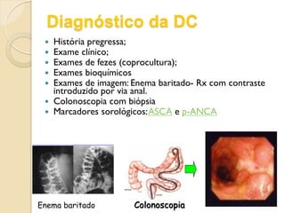 Diagnóstico da DC
 História pregressa;
 Exame clínico;
 Exames de fezes (coprocultura);
 Exames bioquímicos
 Exames de imagem: Enema baritado- Rx com contraste
introduzido por via anal.
 Colonoscopia com biópsia
 Marcadores sorológicos:ASCA e p-ANCA
Enema baritado Colonoscopia
 