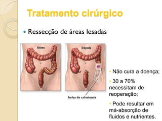 Tratamento cirúrgico
 Ressecção de áreas lesadas
• Não cura a doença;
• 30 a 70%
necessitam de
reoperação;
• Pode resultar em
má-absorção de
fluidos e nutrientes.
 