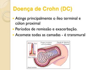 Doença de Crohn (DC)
 Atinge principalmente o íleo terminal e
cólon proximal
 Períodos de remissão e exacerbação.
 Acomete todas as camadas - é transmural
 
