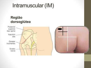 Intramuscular (IM)
Região
dorsoglútea
 