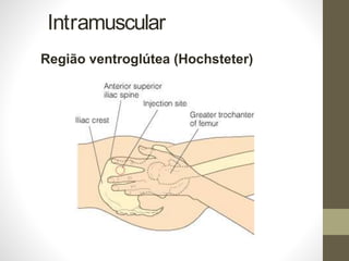 Intramuscular
Região ventroglútea (Hochsteter)
 