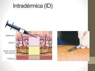 Intradérmica (ID)
 