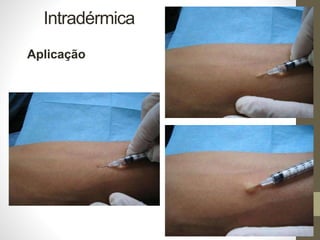 Intradérmica
Aplicação
 