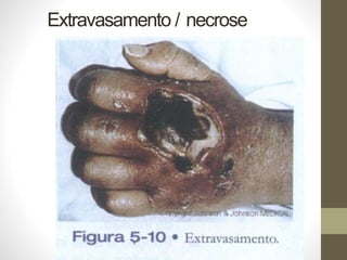 Extravasamento / necrose
 