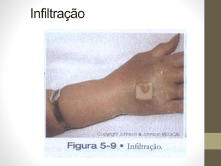 Infiltração
 