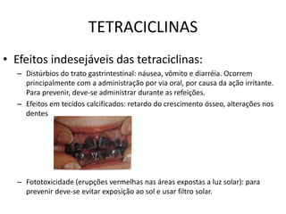 TETRACICLINAS
• Efeitos indesejáveis das tetraciclinas:
– Distúrbios do trato gastrintestinal: náusea, vômito e diarréia. Ocorrem
principalmente com a administração por via oral, por causa da ação irritante.
Para prevenir, deve-se administrar durante as refeições.
– Efeitos em tecidos calcificados: retardo do crescimento ósseo, alterações nos
dentes
– Fototoxicidade (erupções vermelhas nas áreas expostas a luz solar): para
prevenir deve-se evitar exposição ao sol e usar filtro solar.
 