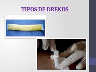 TIPOS DE DRENOS
 