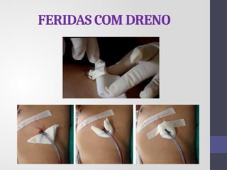 FERIDAS COM DRENO
 